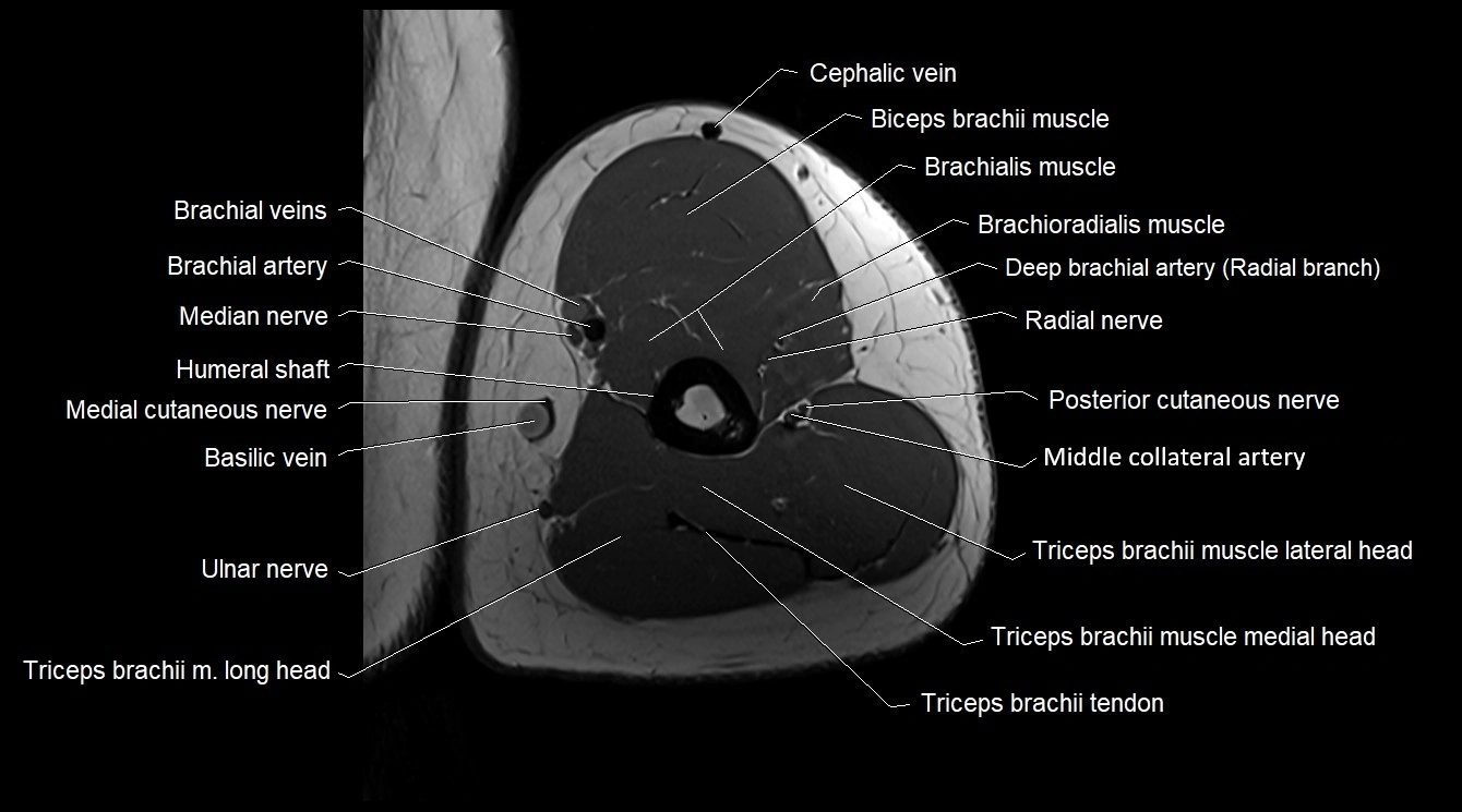 Upper arm( humerus) cross section anatomy MRI 3T axial image 43.webp